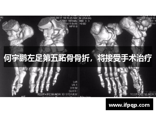 何宇鹏左足第五跖骨骨折，将接受手术治疗